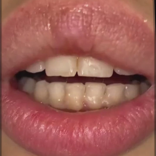 KIT DE BLANCHIMENT DENTAIRE A DOMICILE